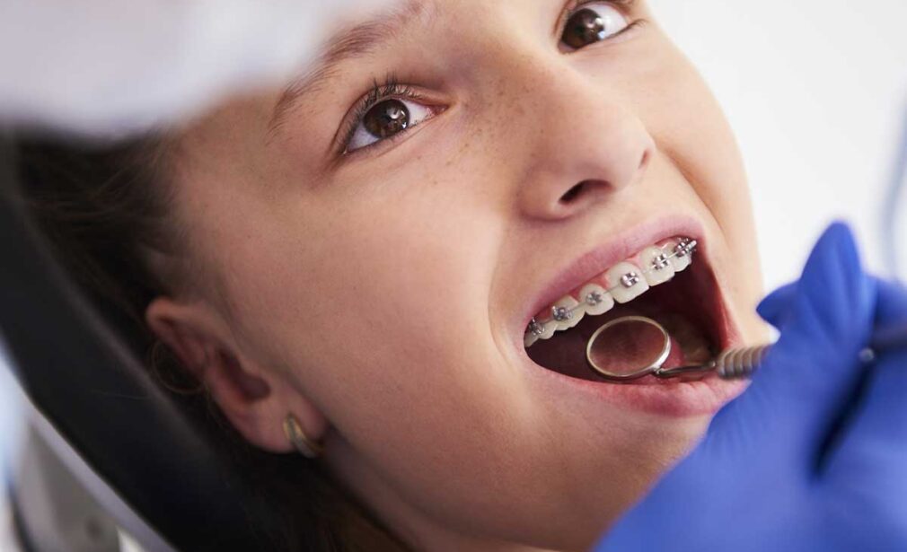 Quando levar o filho ao dentista: o que esperar a partir dos 6 anos
