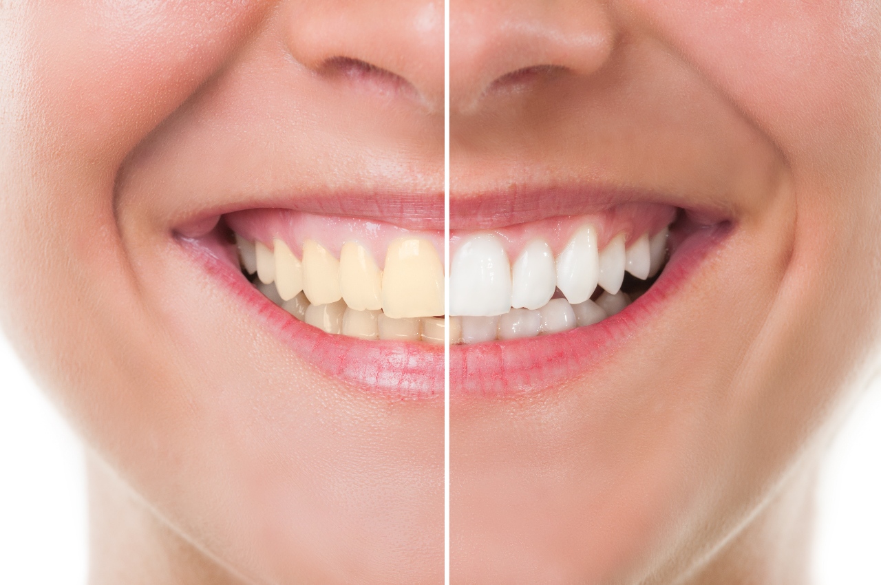 Clareamento dental funciona mesmo? resultados, riscos e cuidados