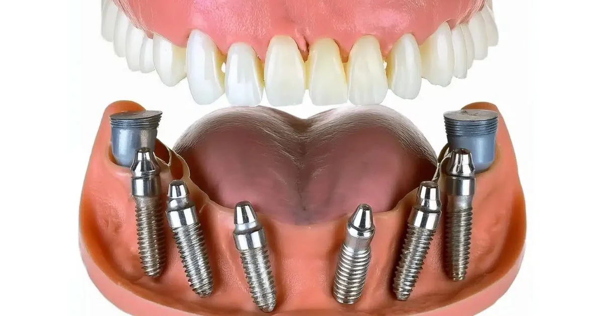 Quanto custa um implante dentário em 2026 e o que influencia no valor
