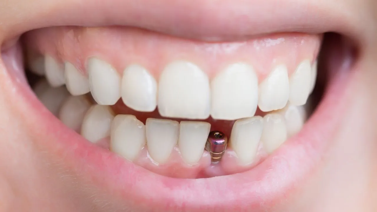 Implante dentário dói? tudo o que você precisa saber antes de fazer