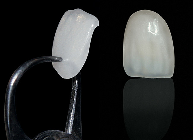 Faceta dentária x lente de contato dental