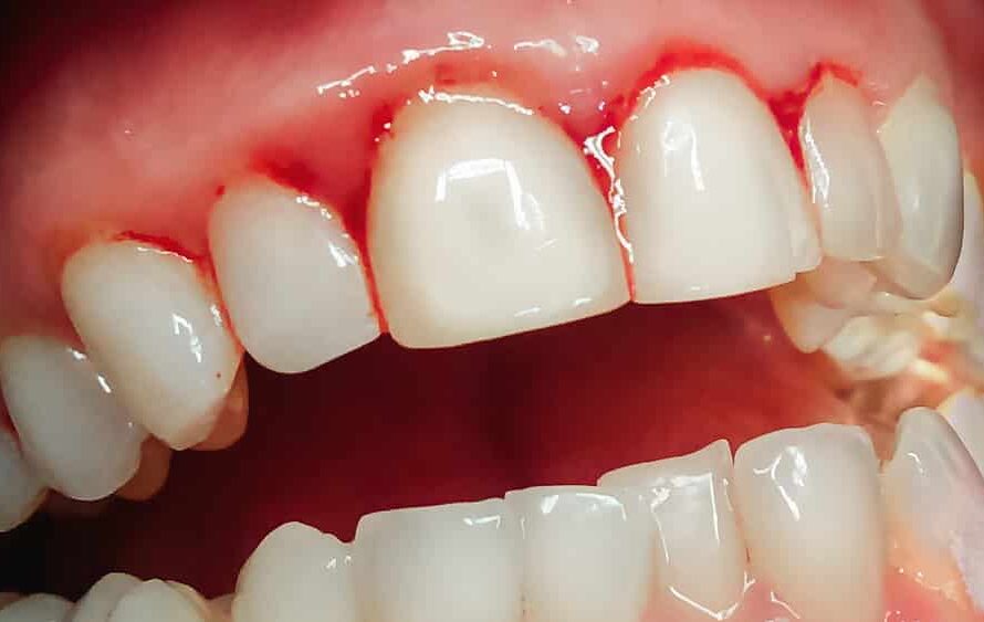 Gengiva sangrando ao escovar: quando é gengivite e quando virou periodontite