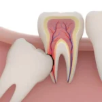 Dente do Siso, Quando Extrair e Como É a Recuperação