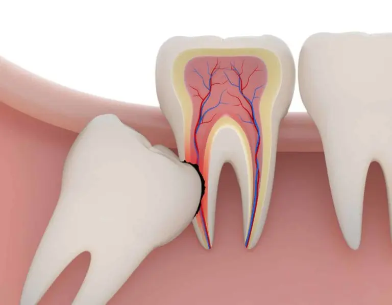 Dente do Siso, Quando Extrair e Como É a Recuperação