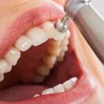 Limpeza Dental De Quanto em Quanto Tempo Fazer