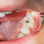Cárie no dente: sinais, restauração ou canal?