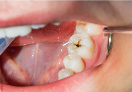 Cárie no dente: sinais, restauração ou canal?